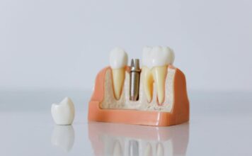 Jak powinna wyglądać codzienna higiena jamy ustnej osób z implantami